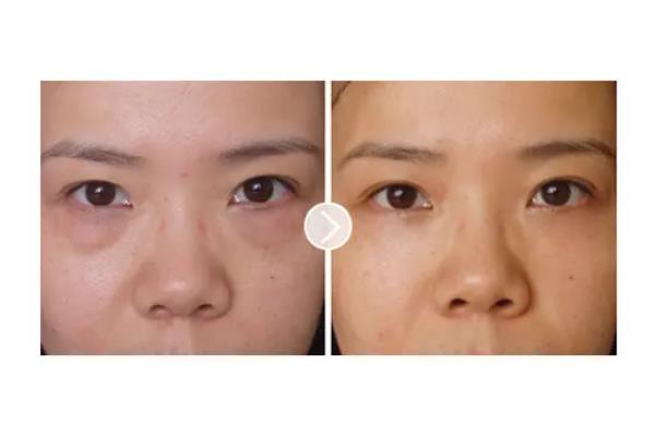 去眼袋手術會失敗嗎 去眼袋手術會導致眼失明嗎 去眼袋手術會失敗嗎 去眼袋手術會導致眼失明嗎