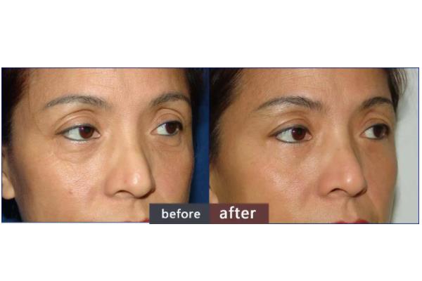 去眼袋手術會失敗嗎 去眼袋手術會導致眼失明嗎 去眼袋手術會失敗嗎 去眼袋手術會導致眼失明嗎