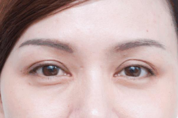 去眼袋手術會失敗嗎 去眼袋手術會導致眼失明嗎 去眼袋手術會失敗嗎 去眼袋手術會導致眼失明嗎