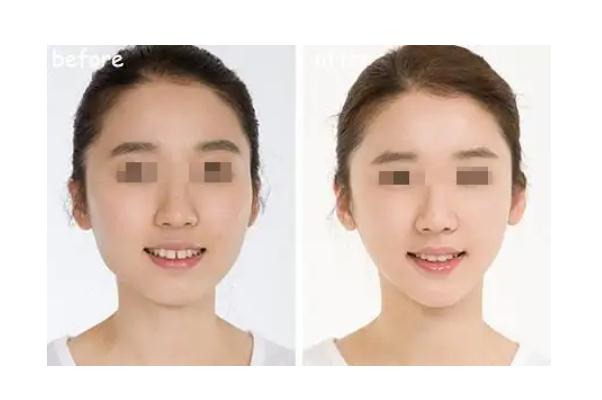 豐下巴哪種方法最好 豐下巴需要多少錢(qián) 豐下巴哪種方法最好 豐下巴需要多少錢(qián)