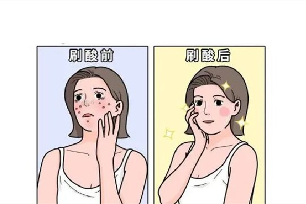 刷酸可以改善黑頭嗎 刷酸對皮膚真的有用嗎 刷酸可以改善黑頭嗎 刷酸對皮膚真的有用嗎