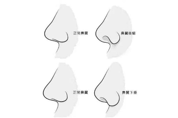 朝天鼻矯正一般多少錢(qián) 朝天鼻矯正風(fēng)險(xiǎn)大嗎 朝天鼻矯正一般多少錢(qián) 朝天鼻矯正風(fēng)險(xiǎn)大嗎