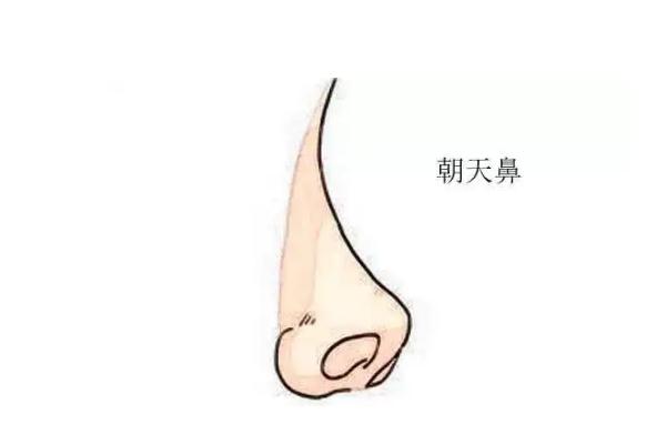 朝天鼻矯正一般多少錢(qián) 朝天鼻矯正風(fēng)險(xiǎn)大嗎 朝天鼻矯正一般多少錢(qián) 朝天鼻矯正風(fēng)險(xiǎn)大嗎