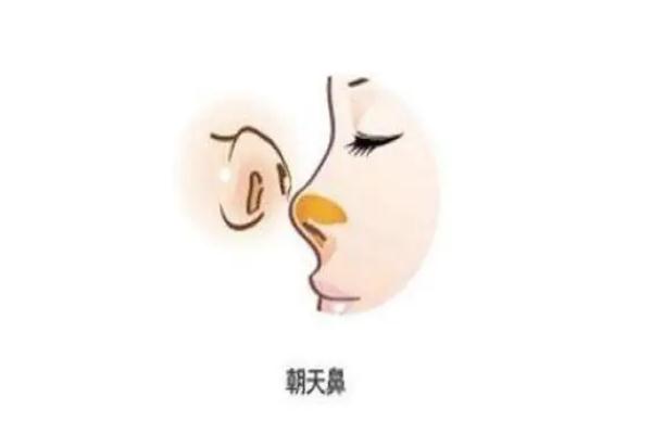 朝天鼻矯正一般多少錢(qián) 朝天鼻矯正風(fēng)險(xiǎn)大嗎 朝天鼻矯正一般多少錢(qián) 朝天鼻矯正風(fēng)險(xiǎn)大嗎