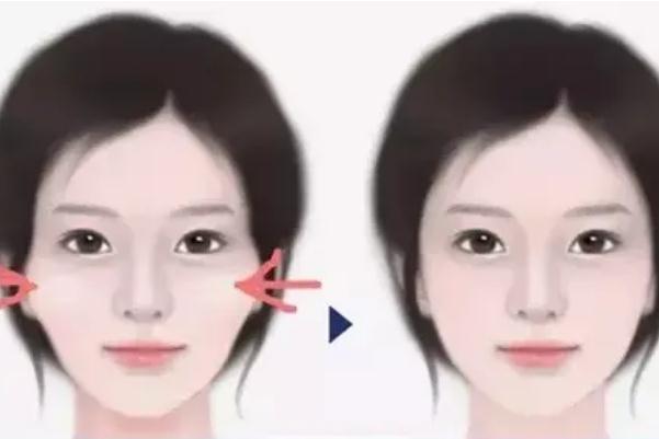 顴骨內(nèi)推要開(kāi)刀嗎 顴骨內(nèi)推有生命危險(xiǎn)嗎 顴骨內(nèi)推要開(kāi)刀嗎 顴骨內(nèi)推有生命危險(xiǎn)嗎