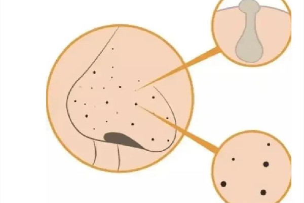 中南路夢(mèng)都?巴厘女子SPA養(yǎng)生會(huì)所去黑頭后效果怎么樣 去黑頭可以去皮膚科嗎 中南路夢(mèng)都?巴厘女子SPA養(yǎng)生會(huì)所去黑頭后效果怎么樣 去黑頭可以去皮膚科嗎